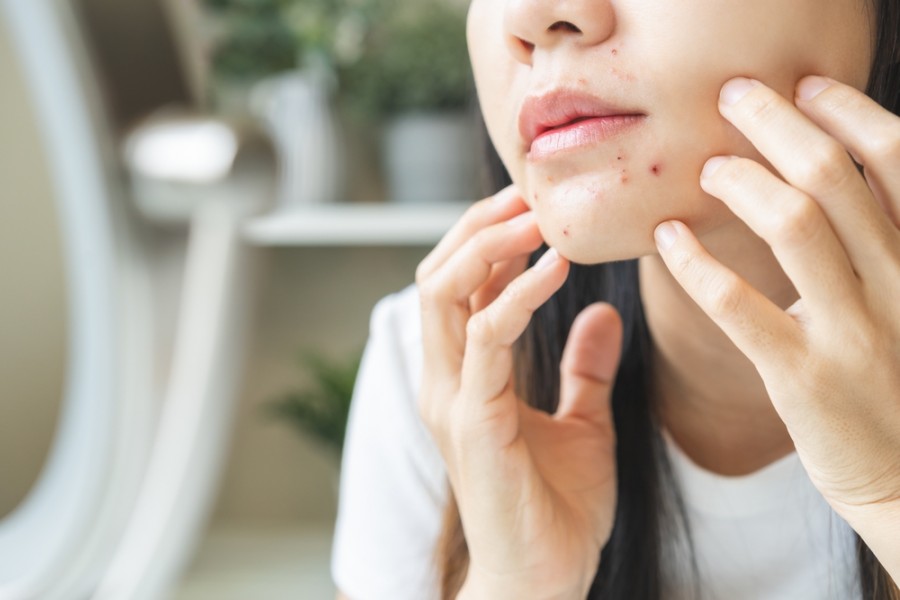 Avis professionnel sur l'impact de Roaccutane sur l'acné
