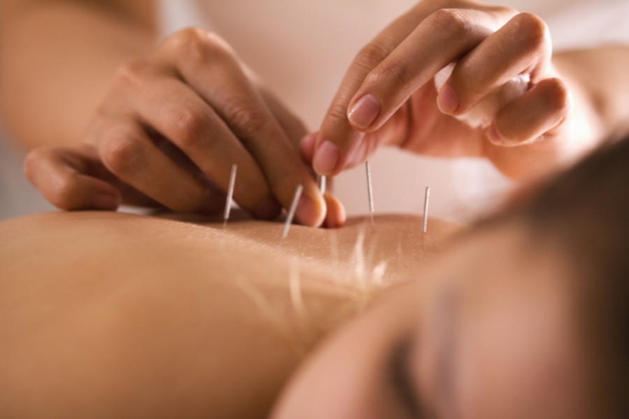 Acupuncteur : quels maux soigne-t-il ?