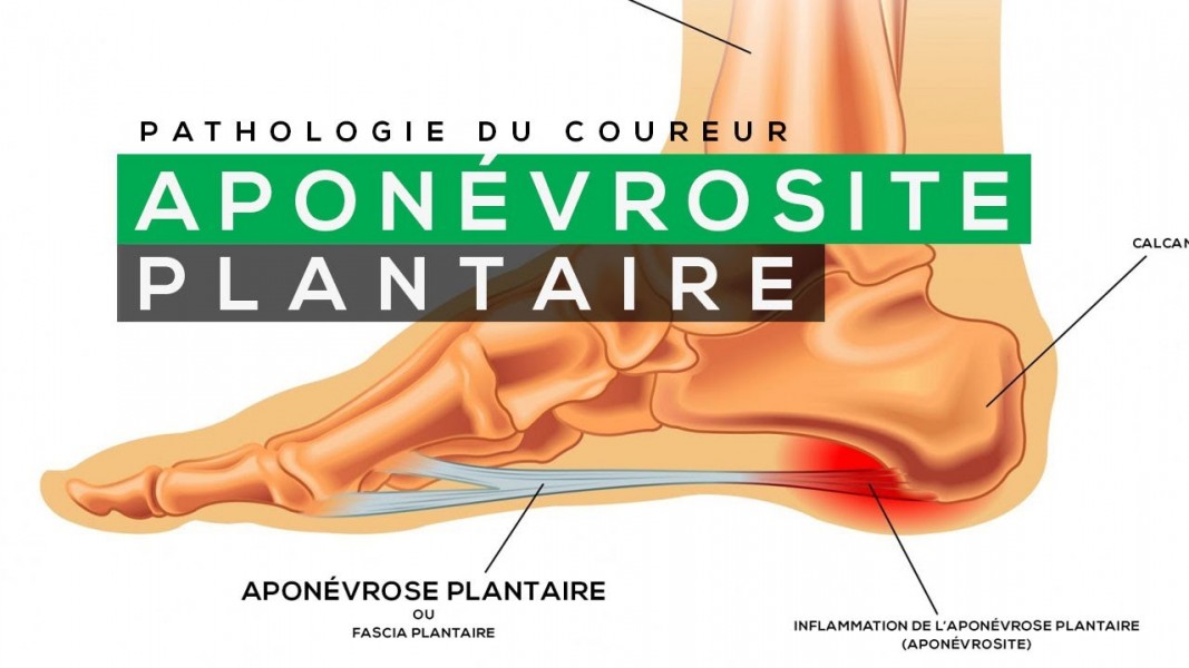 Aponévrose plantaire : pourquoi ai-je mal aux pieds ?