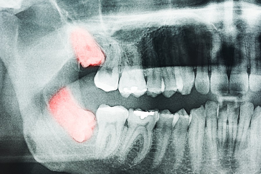 Risques liés à un nerf touché lors de l'extraction d'une dent de sagesse