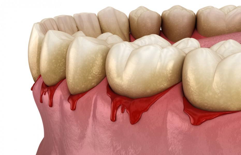 Gencive infectée : comment se soigner rapidement ?