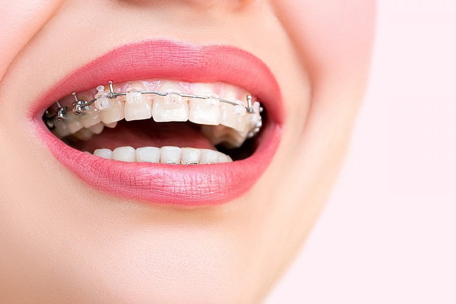 Orthodontie adulte : quels sont les différents traitements possibles ?