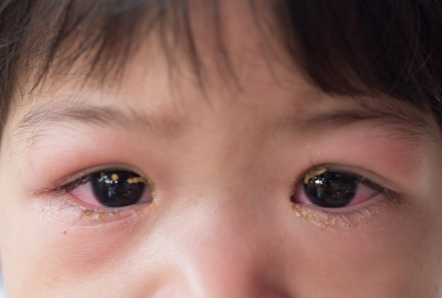 Quelles sont les causes d’un canal lacrymal bouché chez un nourrisson ?