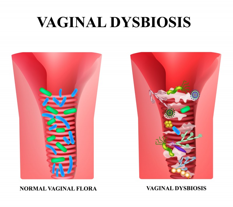 Probiotique vaginaux : à quoi sert-il ?