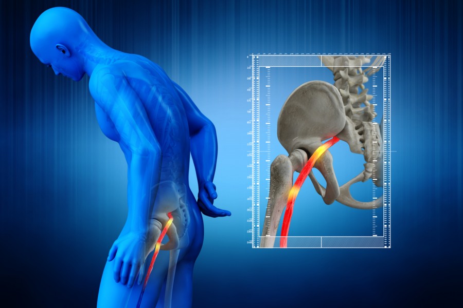 Sciatique paralysante : comment ne plus en souffrir ?